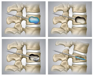 Spine Jack Procedure in Brooklyn, New York - Vertebroplasty, Kyphoplasty