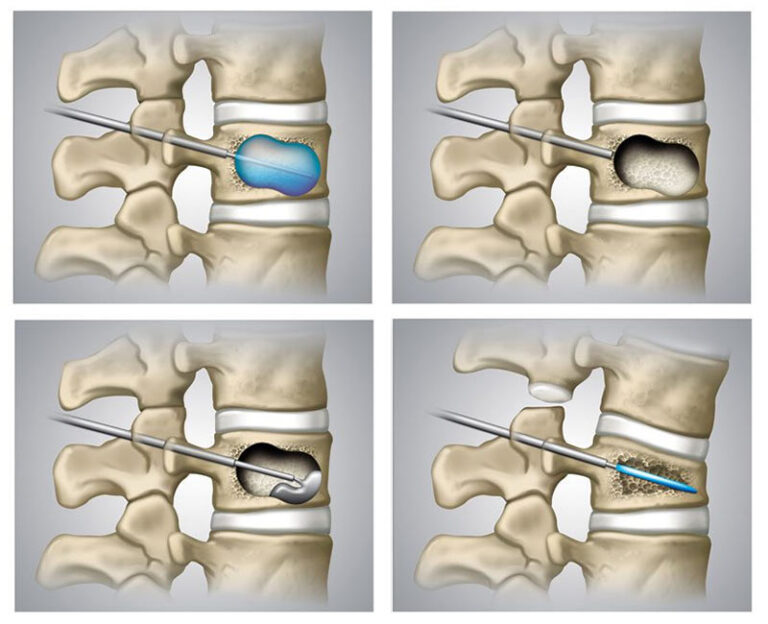 Spine Jack Procedure In Brooklyn New York Vertebroplasty Kyphoplasty