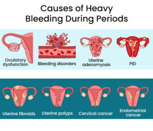 What Causes Heavy Periods, and How You Can Stop Them? | Downtown Vein ...