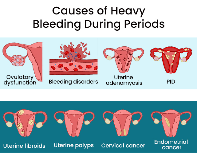 Causes Of Heavy Bleeding During Periods