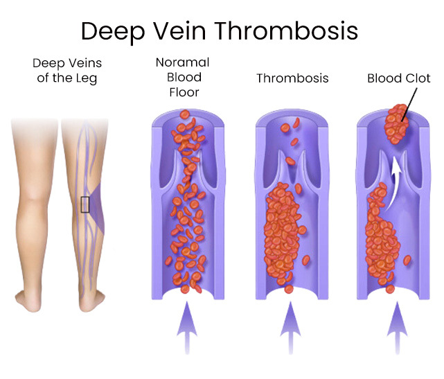 Signs and Symptoms of Blood Clots | Downtown Vein & Vascular