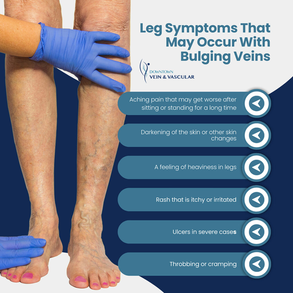 Why Are The Veins in My Feet Bulging? | Downtown Vein & Vascular