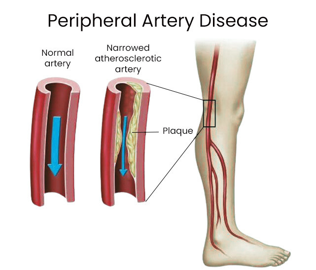 Peripheral Artery Disease