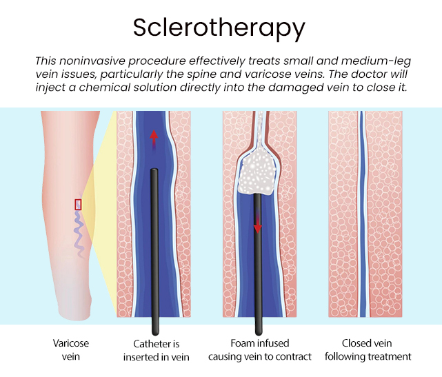 why-do-my-legs-feel-heavy-and-how-can-i-get-this-cured-downtown-vein