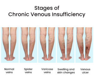 What Causes Hemosiderin Staining | Downtown Vein & Vascular