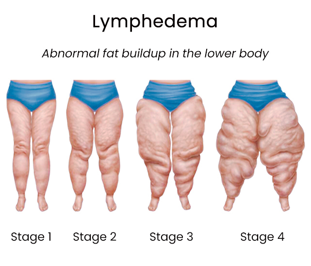 Lipedema Symptoms, Stages, & Treatment
