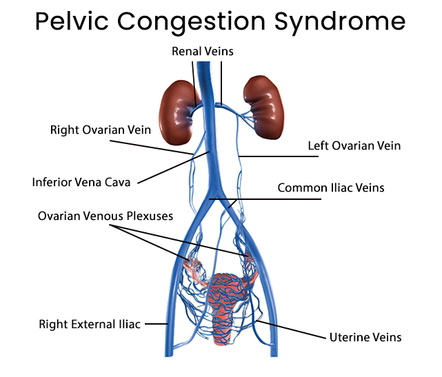 Pelvic Congestion Syndrome (PCS) explained 