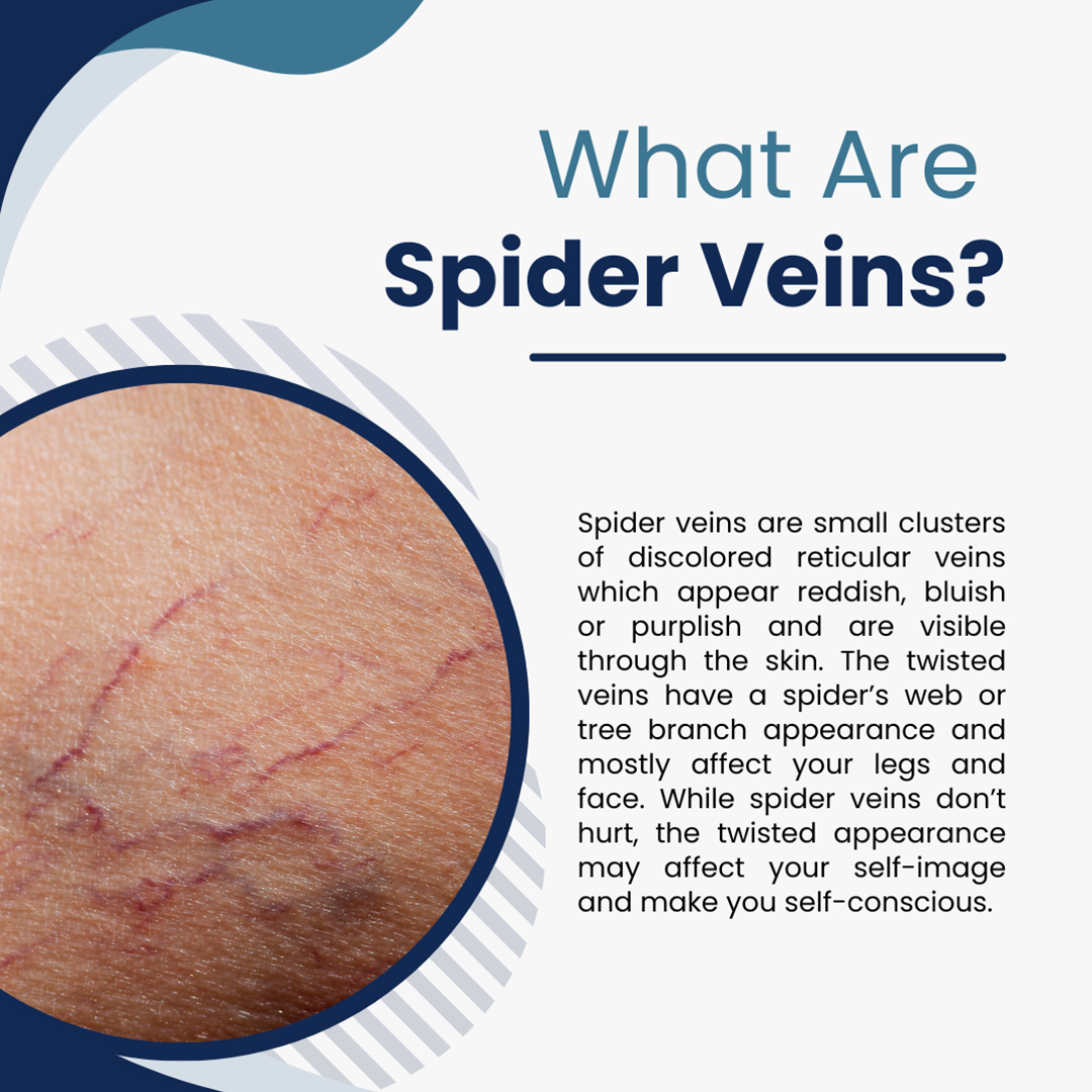 Should I Be Concerned About Dark Veins? - Downtown Vein & Vascular