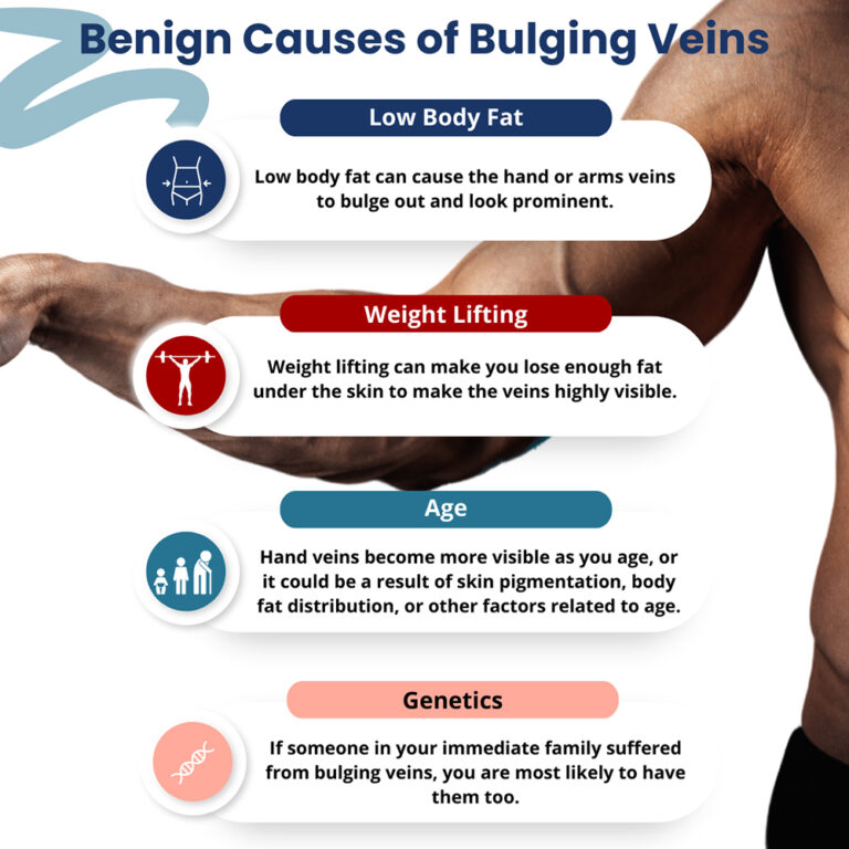 Bulging Veins In Arms And Hands - Downtown Vein & Vascular