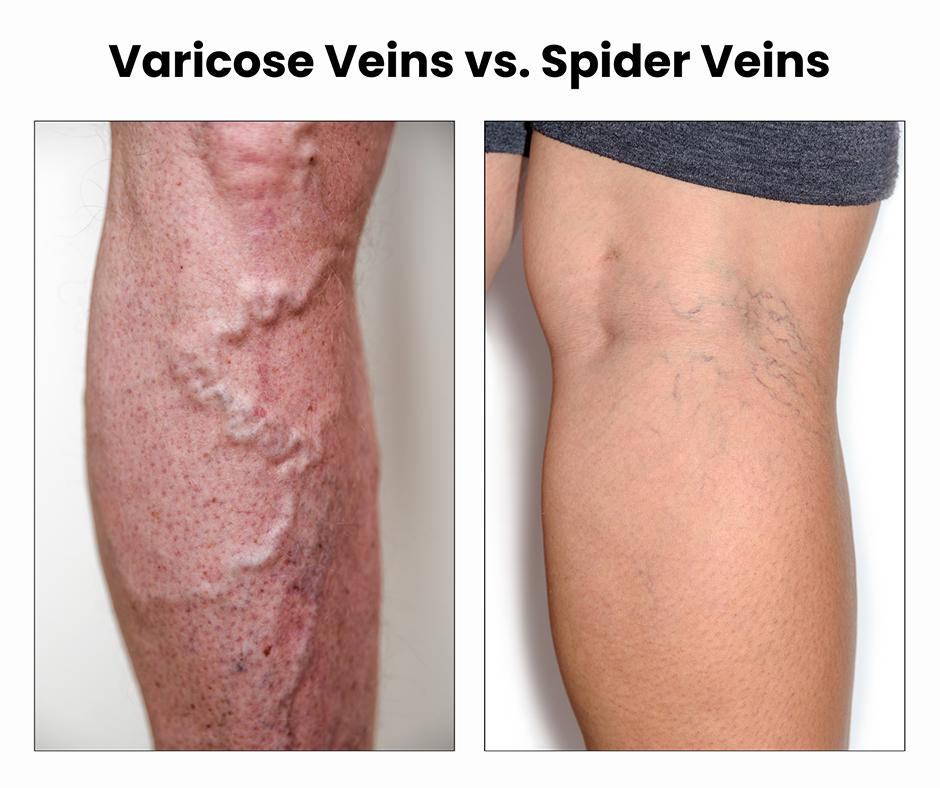 Varicose veins – more than a cosmetic concern
