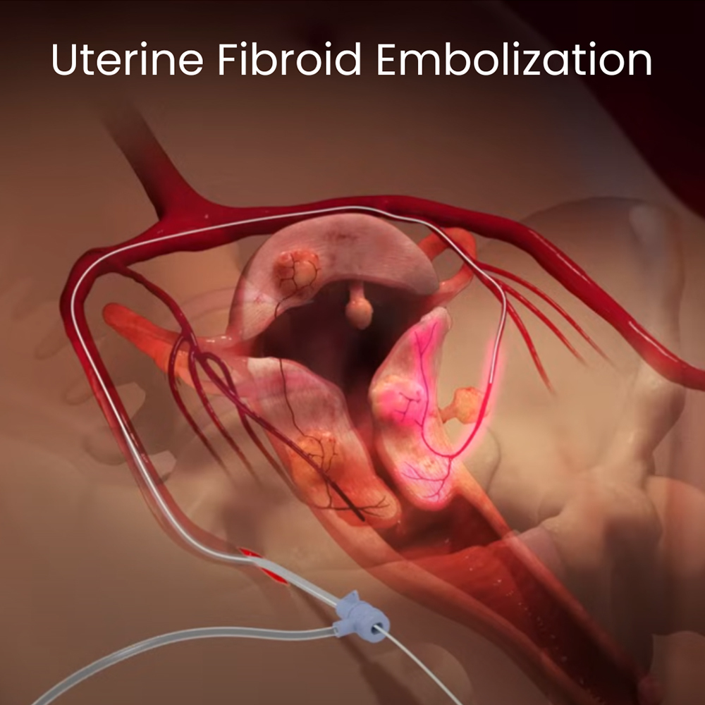 Uterine Fibroid Embolization Ufe Risks Downtown Vein And Vascular